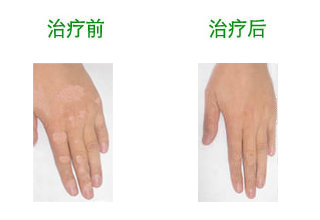 手部白癜风有哪些症状?