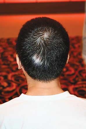 头部白癜风有哪些表现,头部白癜风的症状是什么?