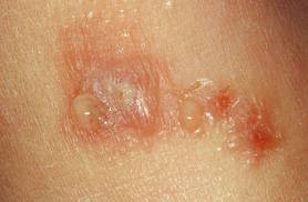 接触性皮炎早期症状是什么? 