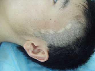 白癜风有什么详细症状