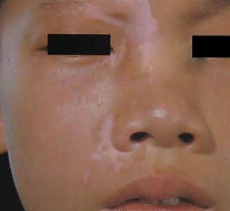 儿童白癜风有什么症状?