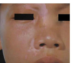 儿童白癜风要怎么治疗才好?