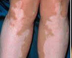 膝盖长白癜风常见的有什么症状图片 