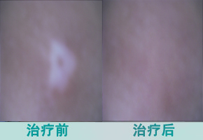 手上白癜风怎么办