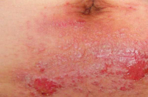 过敏性皮肤病 湿疹   网友提问:"我肛周周围出现了很多红色的疙瘩,我