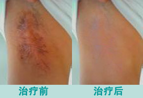 微创手术治疗腋臭会复发吗 