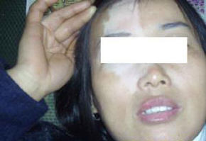 白癜风症状有哪些?