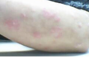 牛皮癣的初期症状特点是什么样的呢?