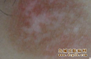 白癜风怎么治疗效果好