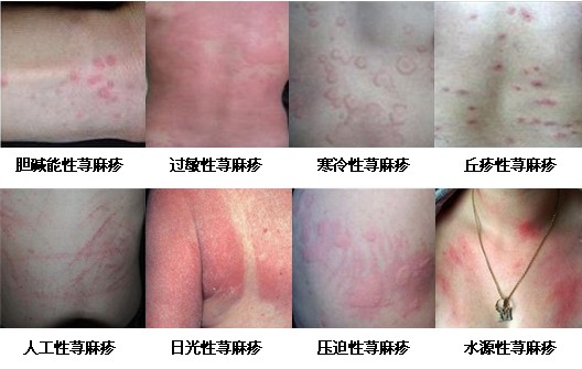 "中药熏蒸疗法"分型治疗荨麻疹效果显著