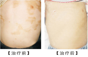 白癜风怎么治疗更有效