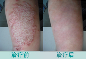 专家详解:牛皮癣如何治疗