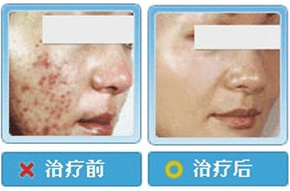 下巴长白色脓包痘痘怎么去除