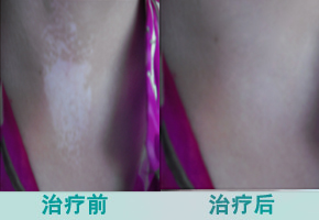 夏季白癜风怎么进行护理