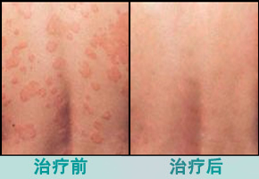 青春痘患者需要注意的饮食事项