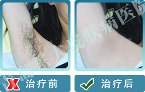 腋臭怎么祛除异味 