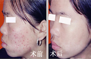 左脸颊长痘痘是什么原因