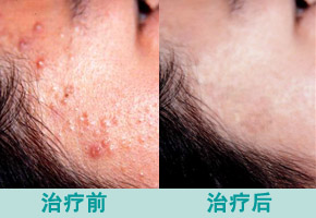 头上长痘痘什么原因