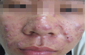 脸颊上长痘痘是什么原因? 