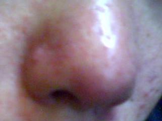 鼻子两边长痘痘是什么原因 