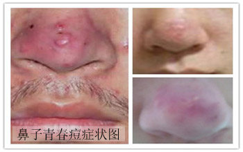 鼻子周围长很多青春痘是什么原因
