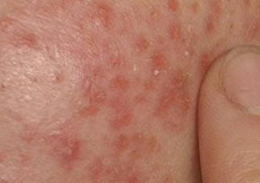 最严重的小腿湿疹症状是什么样 