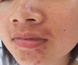 女生脸上长痘痘是什么原因导致的