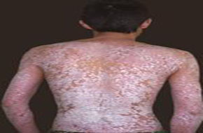 背部皮肤瘙痒起红斑长癣是怎么回事 