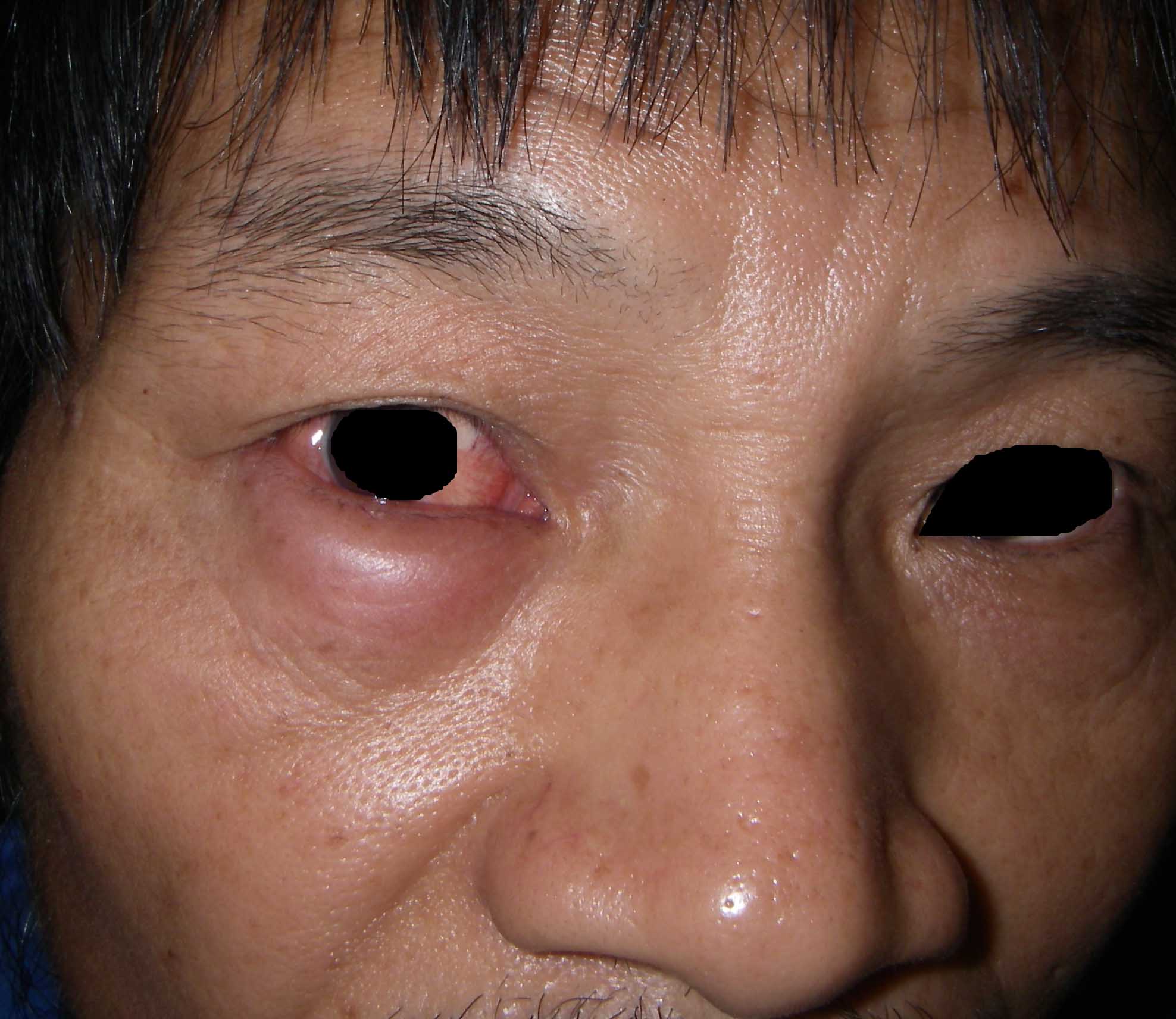 血管性水肿有哪几种类型