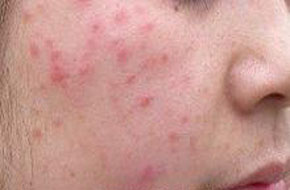 面部脂溢性皮炎有哪些症状 