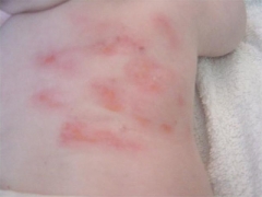 手部湿疹与手癣有什么区别,有什么症状 