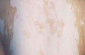 白癜风是如何残害患者的心理健康的?