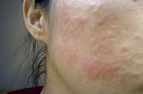 面部湿疹分为哪几种?有哪些症状? 