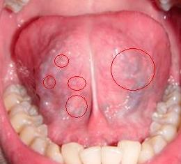 口腔尖锐性湿疣是由人类乳头瘤病毒(hpv)引起的传染 性疾病.