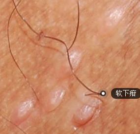 性接触传染上的软下疳有哪些并发症呢