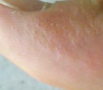 青岛夏季高发的汗疱疹怎么调理呢