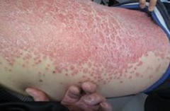牛皮癣患者多吃枇杷能缓解病情吗