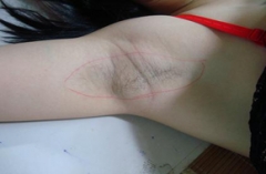 李村女孩腋臭味道很重怎么缓解呢 李村女孩腋臭味道很重怎么缓解呢