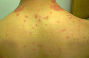 青岛即墨患者身上起红疙瘩有水泡是湿疹吗 