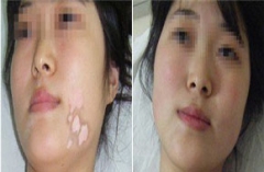 乌梅对于白癜风的治疗有一定帮助吗