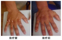 白癜风患者多吃富含酪氨酸的食物对身体有好处吗