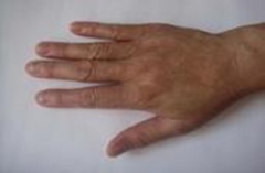 手上长水泡是湿疹还是手足癣 手部湿疹与手足癣药怎样区分 