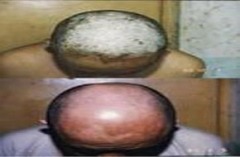 青岛专家介绍哪七种方法能够防止牛皮癣扩散呢