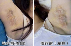 青岛较好的皮肤医院是哪家 狐臭都有哪些治疗方法呢 青岛较好的皮肤医院是哪家 狐臭都有哪些治疗方法呢