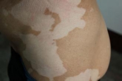 青岛大学医学院附属医院皮肤科专家表示白癜风可能会引发皮肤癌 