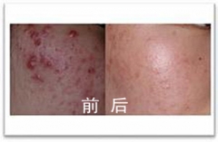 青少年哪些部位容易出现难看的痤疮