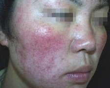 青岛患者咨询:有关于面部激素性皮炎有哪些相关知识