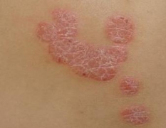青岛患者咨询:怎样做能够降低牛皮癣复发几率