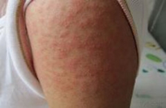 青岛山大医院皮肤科专家总结接触性皮炎的发病与哪些因素有关