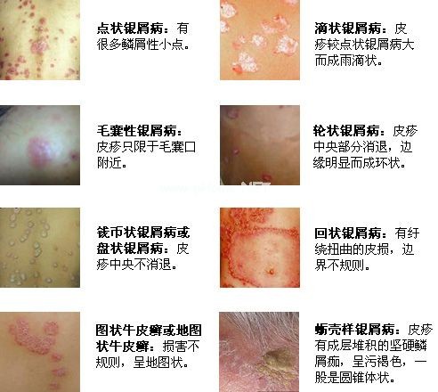 牛皮癣遗传吗?怎么治疗?